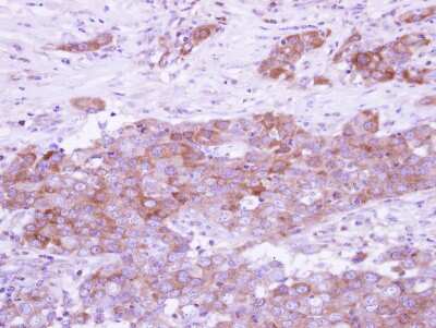 Immunohistochemistry-Paraffin: ARFGAP3 Antibody [NBP2-15443] - Paraffin-embedded Breast ca, using antibody at 1:500 dilution.