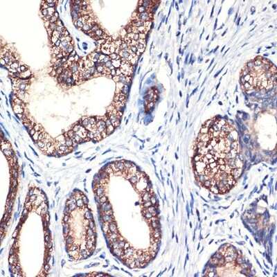 Immunohistochemistry-Paraffin: ARG2 Antibody (1Y5U3) [NBP3-15697] - Immunohistochemistry of paraffin-embedded human prostate cancer using Arginase 2 (ARG2) Rabbit mAb (NBP3-15697) at dilution of 1:100 (40x lens).Perform high pressure antigen retrieval with 10 mM citrate buffer pH 6.0 before commencing with IHC staining protocol.