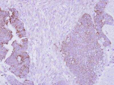 Immunohistochemistry-Paraffin: ARG2 Antibody [NBP2-15446] - Human colon carcinoma, using Arginase II  antibody at 1:250 dilution. Antigen Retrieval: Trilogy™ (EDTA based, pH 8.0) buffer, 15min.