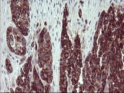 Immunohistochemistry: ARG2 Antibody (OTI3G5) - Azide and BSA Free [NBP2-70205] - Analysis of Adenocarcinoma of Human colon tissue. (Heat-induced epitope retrieval by 10mM citric buffer, pH6.0, 120C for 3min)