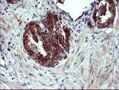 Immunohistochemistry: ARG2 Antibody (OTI3G5) - Azide and BSA Free [NBP2-70205] - Analysis of Carcinoma of Human prostate tissue. (Heat-induced epitope retrieval by 10mM citric buffer, pH6.0, 120C for 3min)