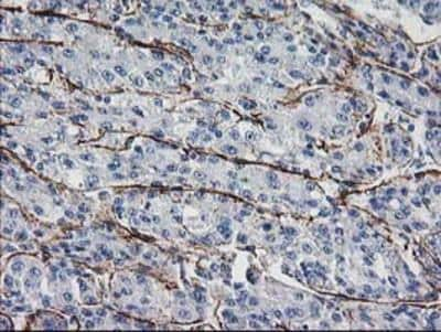 Immunohistochemistry-Paraffin: ARH Antibody (7E11) [NBP2-01435] - Staining of paraffin-embedded Carcinoma of Human liver tissue using anti-ARH mouse monoclonal antibody.