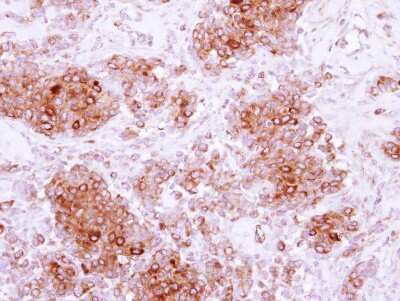 Immunohistochemistry-Paraffin: ARH Antibody [NBP2-15449] - Immunohistochemical analysis of paraffin-embedded Breast ca, using antibody at 1:500 dilution.