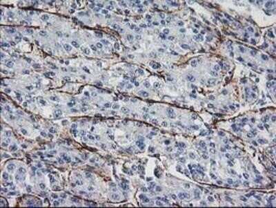Immunohistochemistry: ARH Antibody (OTI7E11) - Azide and BSA Free [NBP2-71790] - Staining of paraffin-embedded Carcinoma of Human liver tissue using anti-ARH mouse monoclonal antibody.
