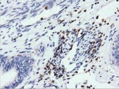 Immunohistochemistry: ARHGAP25 Antibody (OTI2D5) - Azide and BSA Free [NBP2-71508] - Staining of paraffin-embedded Adenocarcinoma of Human endometrium tissue using anti-ARHGAP25 mouse monoclonal antibody.