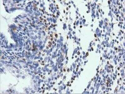 Immunohistochemistry-Paraffin: ARHGAP25 Antibody (OTI2D5) [NBP2-03024] - Staining of paraffin-embedded Carcinoma of Human prostate tissue using anti-ARHGAP25 mouse monoclonal antibody.