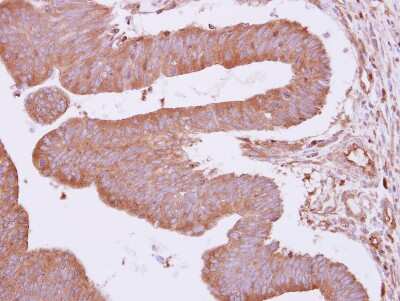 Immunohistochemistry-Paraffin: ARHGAP4 Antibody [NBP1-31976] - Paraffin-embedded Colon ca, using antibody at 1:500 dilution.