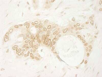 Immunohistochemistry-Paraffin: ARHGEF16 Antibody [NBP1-06499] - Human ovarian carcinoma. Antibody used at a dilution of 1:200 (1ug/ml).