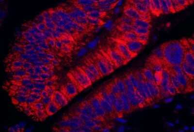 <b>Independent Antibodies Validation. </b>Immunohistochemistry-Paraffin: ARHGEF5 Antibody [NBP1-23000] - FFPE section of human colon carcinoma. Antibody: Affinity purified rabbit anti-APC7 used at a dilution of 1:200 (1ug/ml). Detection: DAB