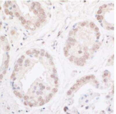 Immunohistochemistry-Paraffin: ARID2 Antibody [NBP1-26615] - FFPE section of human prostate carcinoma. Antibody: Affinity purified rabbit anti-ARID2  used at a dilution of 1:5,000 ( 0.2ug/ml). Detection: DAB