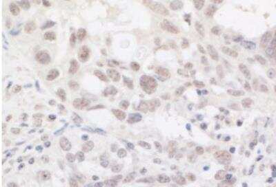 Immunohistochemistry-Paraffin: ARID2 Antibody [NBP1-26615] - FFPE section of human ovarian carcinoma. Antibody: Affinity purified rabbit anti-ARID2  used at a dilution of 1:5,000 ( 0.2ug/ml). Detection: DAB