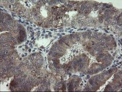 Immunohistochemistry: ARL2BP Antibody (OTI1A10) - Azide and BSA Free [NBP2-71743] - Analysis of Adenocarcinoma of Human endometrium tissue.