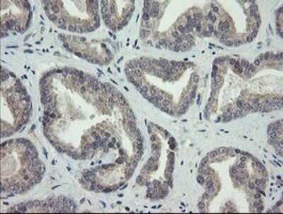 Immunohistochemistry: ARL2BP Antibody (OTI1A10) - Azide and BSA Free [NBP2-71743] - Analysis of Carcinoma of Human prostate tissue.