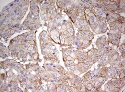 Immunohistochemistry: ARL3 Antibody (OTI1C6) - Azide and BSA Free [NBP2-70206] - Analysis of Carcinoma of Human liver tissue.(Heat-induced epitope retrieval by 10mM citric buffer, pH6.0, 120C for 3min)