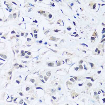 Immunohistochemistry-Paraffin: ARL6IP4 Antibody [NBP3-04956] - Paraffin-embedded human breast cancer using ARL6IP4 antibody at dilution of 1:100 (40x lens).