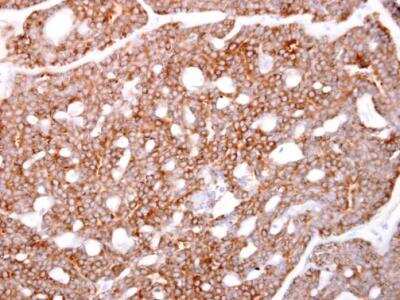 Immunohistochemistry-Paraffin: ARPC1A Antibody [NBP2-15470] - Paraffin-embedded human breast carcinoma. ARPC1A antibody diluted at 1:500.