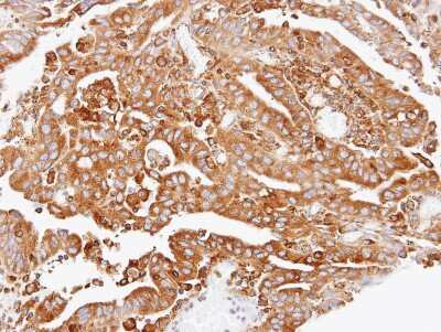 Immunohistochemistry-Paraffin: ARPC2 Antibody [NBP1-32297] -  OVCA xenograft, using ARPC2 antibody at 1:100 dilution.  Antigen Retrieval: Trilogy™ (EDTA based, pH 8.0) buffer, 15min. 