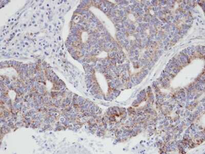 Immunohistochemistry-Paraffin: ARPC3 Antibody [NBP1-31422] - Paraffin-embedded endo mitral OVCA, using antibody at 1:100 dilution.