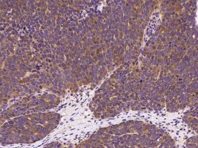 Immunohistochemistry-Paraffin: ARPC3 Antibody [NBP2-99559] - Immunochemical staining of human ARPC3 in human ovarian cancer with rabbit polyclonal antibody at 1:1000 dilution, formalin-fixed paraffin embedded sections.