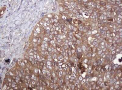 Immunohistochemistry: ARPC5 Antibody (2G1) [NBP2-45504] - Analysis of Adenocarcinoma of Human ovary tissue. (Heat-induced epitope retrieval by 10mM citric buffer, pH6.0, 120C for 3min)