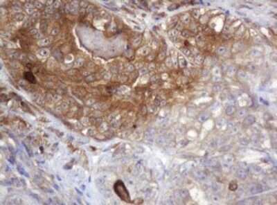 Immunohistochemistry: ARPC5 Antibody (2G1) [NBP2-45504] - Analysis of Adenocarcinoma of Human colon tissue. (Heat-induced epitope retrieval by 10mM citric buffer, pH6.0, 120C for 3min)