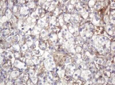 Immunohistochemistry: ARPC5 Antibody (OTI2G1) - Azide and BSA Free [NBP2-71550] - Analysis of Carcinoma of Human kidney tissue. (Heat-induced epitope retrieval by 10mM citric buffer, pH6.0, 120C for 3min)