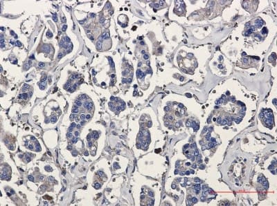 Immunohistochemistry-Paraffin: ARPC5 Antibody (S08-2B3) [NBP3-19937] - Immunohistochemistry of ARPC5 in paraffin-embedded Human Cholangiocarcinoma using NBP3-19937 at dilution 1/20