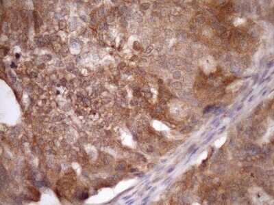Immunohistochemistry: ASB8 Antibody (OTI3A12) - Azide and BSA Free [NBP2-72400] - Analysis of Carcinoma of Human liver tissue. (Heat-induced epitope retrieval by Tris-EDTA, pH8.0)(1:150)