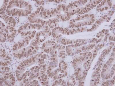 Immunohistochemistry-Paraffin: ASC1 Antibody [NBP2-15486] - Immunohistochemical analysis of paraffin-embedded Colon ca, using antibody at 1:250 dilution.