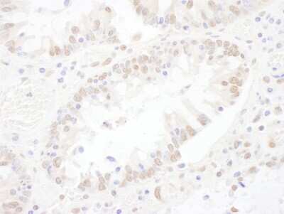 <b>Independent Antibodies Validation and Biological Strategies Validation.</b>Immunohistochemistry-Paraffin: ASCC3L1 Antibody [NBP1-79036] - Sample: FFPE section of human colon carcinoma. Antibody: Affinity purified rabbit anti- SNRNP200 used at a dilution of 1:200 (1ug/ml). Detection: DAB. Counterstain: hematoxylin (blue).
