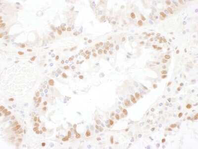 <b>Independent Antibodies Validation and Biological Strategies Validation.</b>Immunohistochemistry-Paraffin: ASCC3L1 Antibody [NBP1-79037] - Sample: FFPE section of human colon carcinoma. Antibody: Affinity purified rabbit anti- SNRNP200 used at a dilution of 1:1,000 (1ug/ml). Detection: DAB. Counterstain: hematoxylin (blue).