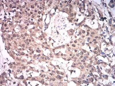 Immunohistochemistry: ASH2L Antibody (6B10H10) [NBP2-61686] - Analysis of paraffin-embedded esophageal cancer tissues using ASH2L mouse mAb with DAB staining.