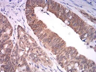 Immunohistochemistry: ASH2L Antibody (6B10H10) [NBP2-61686] - Analysis of paraffin-embedded rectum cancer tissues using ASH2L mouse mAb with DAB staining.