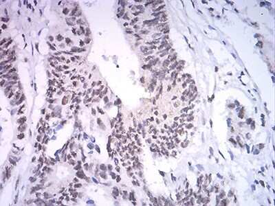 Immunohistochemistry-Paraffin: ASH2L Antibody (6F6B9) [NBP2-61685] - Analysis of rectum cancer tissues using ASH2L mouse mAb with DAB staining.