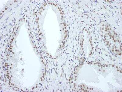 <b>Independent Antibodies Validation. </b>Immunohistochemistry-Paraffin: ASH2L Antibody [NB600-281] - Sample: FFPE section of human prostate carcinoma. Antibody: Affinity purified rabbit anti- ASH2 used at a dilution of 1:1,000 (1ug/ml). Detection: DAB. Counterstain: IHC Hematoxylin (blue).