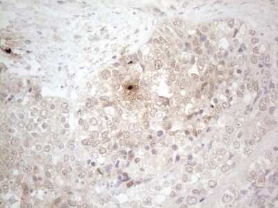 Immunohistochemistry: ASPA Antibody (OTI3G5) - Azide and BSA Free [NBP2-70216] - Analysis of Adenocarcinoma of Human endometrium tissue. (Heat-induced epitope retrieval by 1mM EDTA in 10mM Tris buffer (pH8.5) at 120C for 3 min)(1:150)