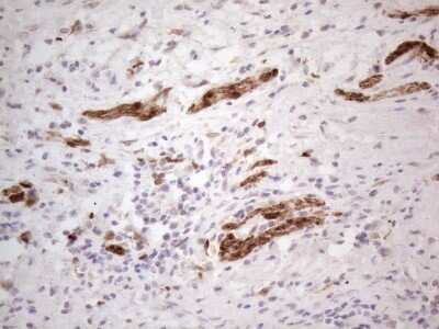 Immunohistochemistry: ASPA Antibody (OTI3G5) - Azide and BSA Free [NBP2-70216] - Analysis of Carcinoma of Human bladder tissue. (Heat-induced epitope retrieval by 1mM EDTA in 10mM Tris buffer (pH8.5) at 120C for 3 min)