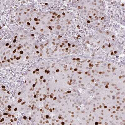Immunohistochemistry-Paraffin: ATAD2 Antibody (CL0182) [NBP2-14786] - Staining of human breast cancer shows moderate to strong nuclear positivity in tumor cells.