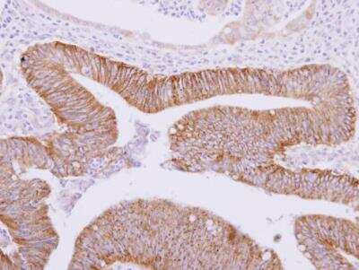 Immunohistochemistry-Paraffin: ATAD3A Antibody [NBP2-14881] - Paraffin-embedded colon carcinoma. ATAD3A antibody  dilution: 1:500.