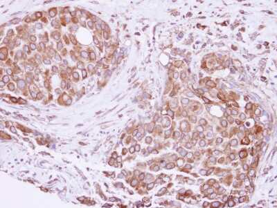 Immunohistochemistry-Paraffin: ATE1 Antibody [NBP2-15494] - Immunohistochemical analysis of paraffin-embedded Breast ca, using antibody at 1:250 dilution.