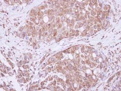 Immunohistochemistry-Paraffin: ATE1 Antibody [NBP2-15495] - Immunohistochemical analysis of paraffin-embedded Breast ca, using antibody at 1:250 dilution.