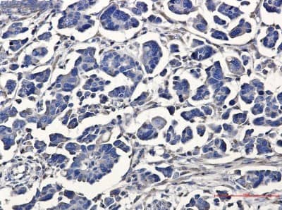 Immunohistochemistry-Paraffin: ATE1 Antibody (S09-6D4) [NBP3-19575] - Immunohistochemistry of ATE1 in paraffin-embedded Human Cholangiocarcinoma using NBP3-19575 at dilution 1/20