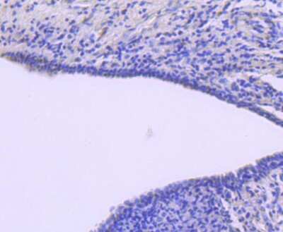 Immunohistochemistry-Paraffin: ATF1 Antibody (JJ207-04) [NBP2-67856] - Analysis of paraffin-embedded human breast carcinoma tissue using anti-ATF1 antibody. Counter stained with hematoxylin.