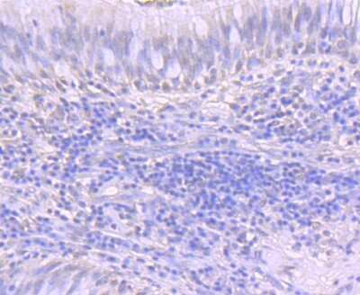 Immunohistochemistry-Paraffin: ATF1 Antibody (JJ207-04) [NBP2-67856] - Analysis of paraffin-embedded human lung cancer tissue using anti-ATF1 antibody. Counter stained with hematoxylin.