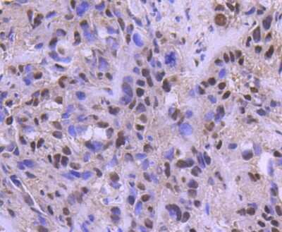 Immunohistochemistry-Paraffin: ATF2 Antibody (SZ17-01) [NBP2-67354] - Analysis of paraffin-embedded human breast carcinoma tissue using anti-ATF2 antibody. Counter stained with hematoxylin.