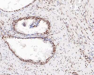 Immunohistochemistry-Paraffin: ATF2 [p Thr71] Antibody (SC05-90) [NBP2-67573] - Immunohistochemical analysis of paraffin-embedded human prostate tissue using anti-ATF2 antibody. The section was pre-treated using heat mediated antigen retrieval with sodium citrate buffer (pH 6.0) for 20 minutes. The tissues were blocked in 5% BSA for 30 minutes at room temperature, washed with ddH2O and PBS, and then probed with the primary antibody (ET1610-30, 1/200) for 30 minutes at room temperature. The detection was performed using an HRP conjugated compact polymer system. DAB was used as the chromogen. Tissues were counterstained with hematoxylin and mounted with DPX.