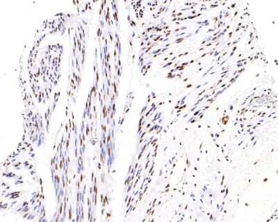 Immunohistochemistry-Paraffin: ATF2 [p Thr71] Antibody (SC05-90) [NBP2-67573] - Analysis of paraffin-embedded human cervix tissue with Rabbit anti-ATF2 [p Thr71] antibody washed with ddH2O and PBS, and then probed with the primary antibody  at 1/200 dilution for 1 hour at room temperature. The detection was performed using an HRP conjugated compact polymer system. DAB was used as the chromogen. Tissues were counterstained with hematoxylin and mounted with DPX.