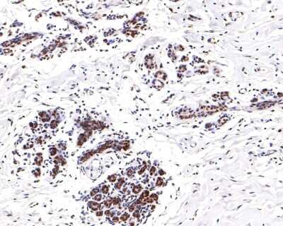 Immunohistochemistry-Paraffin: ATF2 [p Thr71] Antibody (SC05-90) [NBP2-67573] - Analysis of paraffin-embedded human breast tissue with Rabbit anti-ATF2 [p Thr71] antibody washed with ddH2O and PBS, and then probed with the primary antibody at 1/200 dilution for 1 hour at room temperature. The detection was performed using an HRP conjugated compact polymer system. DAB was used as the chromogen. Tissues were counterstained with hematoxylin and mounted with DPX.