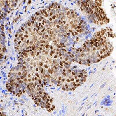 Immunohistochemistry: ATF6 Antibody (2358C) [NBP2-76329] - ATF6 was detected in immersion fixed paraffin-embedded sections of human prostate using Rabbit Anti-Human/Mouse/Rat ATF6 Monoclonal Antibody (Catalog # NBP2-76329) at 0.3 ug/mL for 1 hour at room temperature followed by incubation with the Anti-Rabbit IgG VisUCyte(TM) HRP Polymer Antibody (Catalog # VC003). Before incubation with the primary antibody, tissue was subjected to heat-induced epitope retrieval using Antigen Retrieval Reagent-Basic (Catalog # CTS013). Tissue was stained using DAB (brown) and counterstained with hematoxylin (blue). Specific staining was localized to cytoplasm and nuclei.