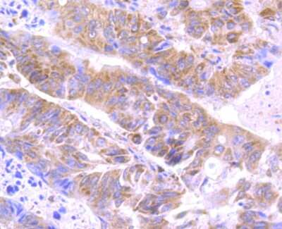Immunohistochemistry-Paraffin: ATG3/APG3 Antibody (JU00-35) [NBP2-75414] - Analysis of paraffin-embedded human colon cancer tissue using anti-Apg3 antibody. Counter stained with hematoxylin.